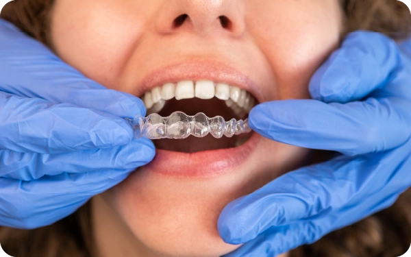 Damon self-ligating low friction braces
