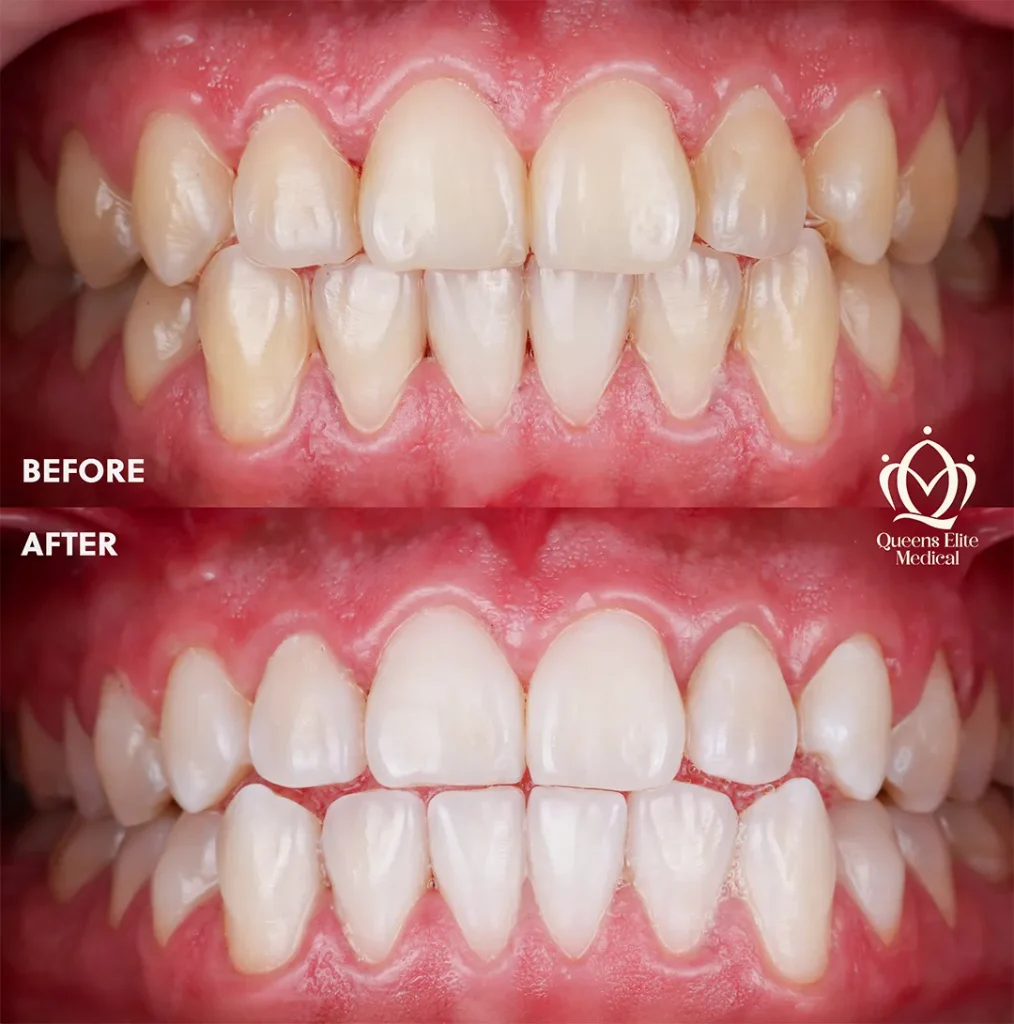 Philips Zoom in-office teeth whitening results