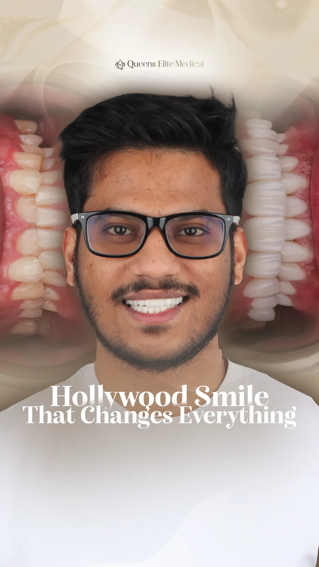 Hollywood Smile veneer makeover for patient Manan
