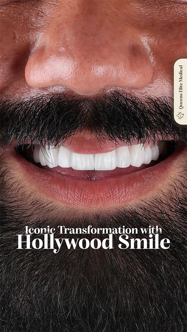 Hollywood Smile veneer transformation case at Queens Elite Medical