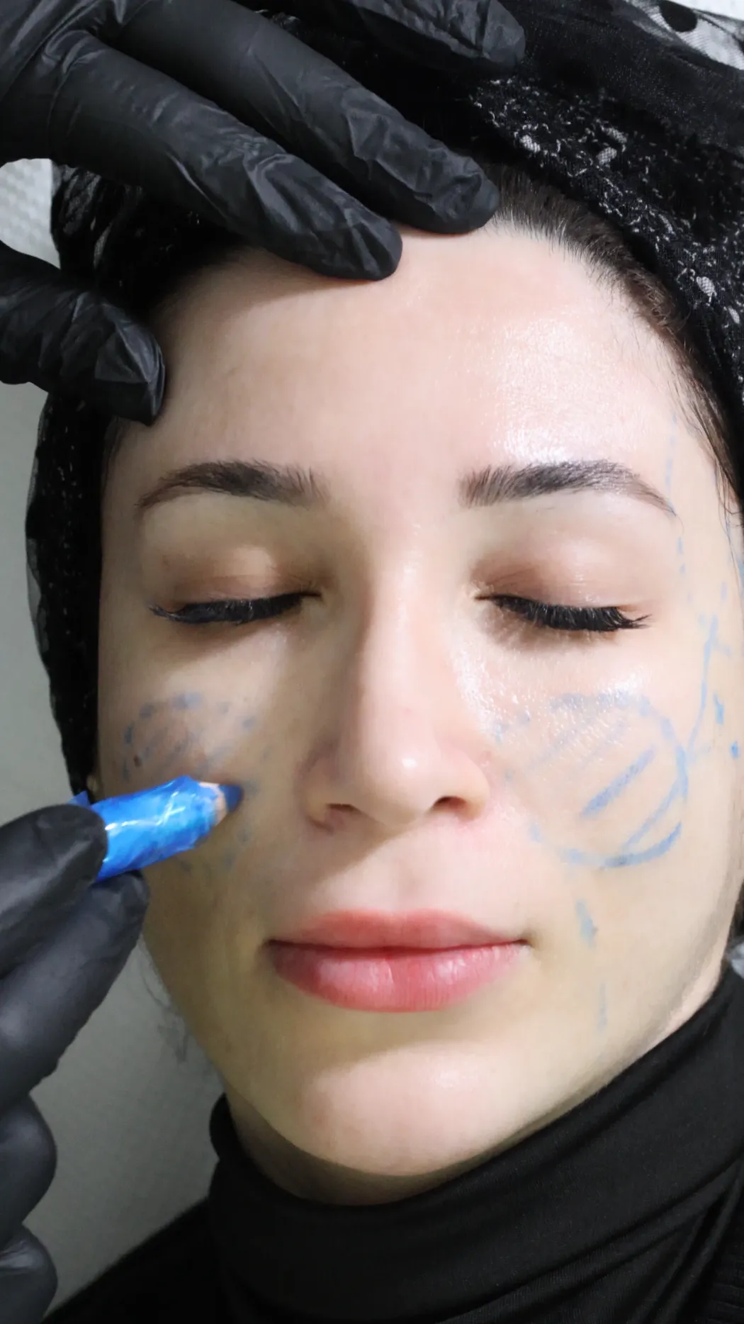 HIFU non-surgical ultrasound facelift