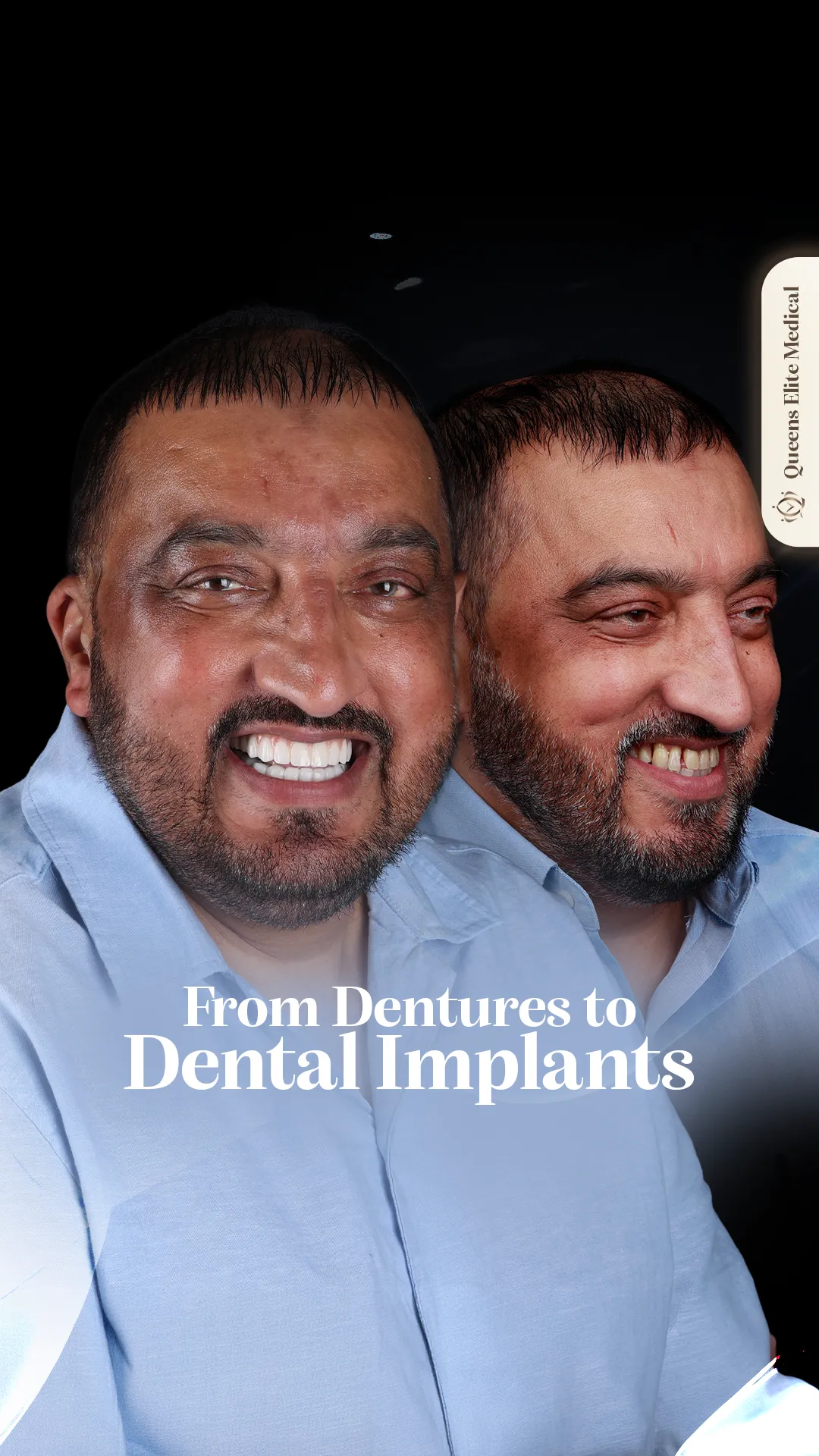 Single dental implant restoration by Dr. Haroon Malik
